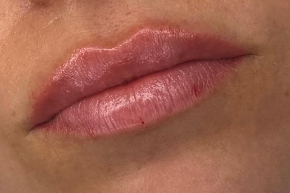 aumento de labios madrid