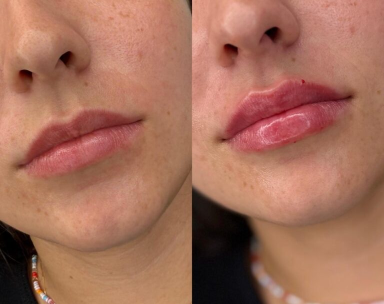 Aumento de labios natural en Madrid antes y después