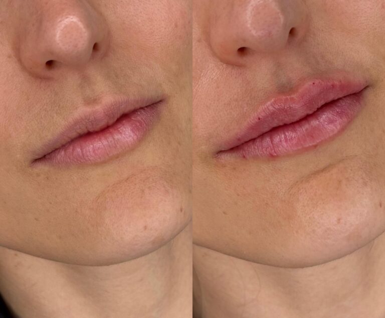 Aumento de labios primera vez - resultado natural