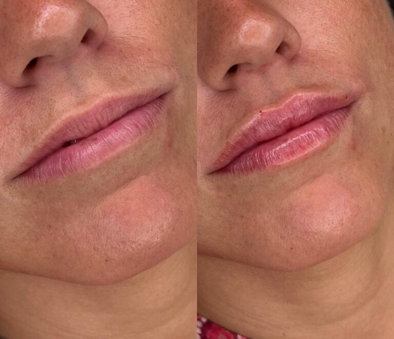 Labios definidos sin efecto pato - Madrid