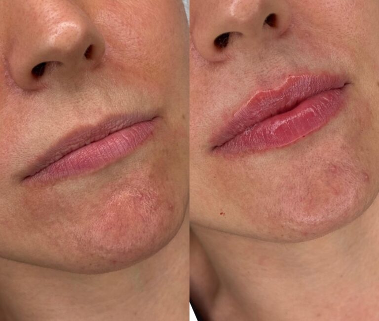 Labios hidratados con ácido hialurónico - antes y después