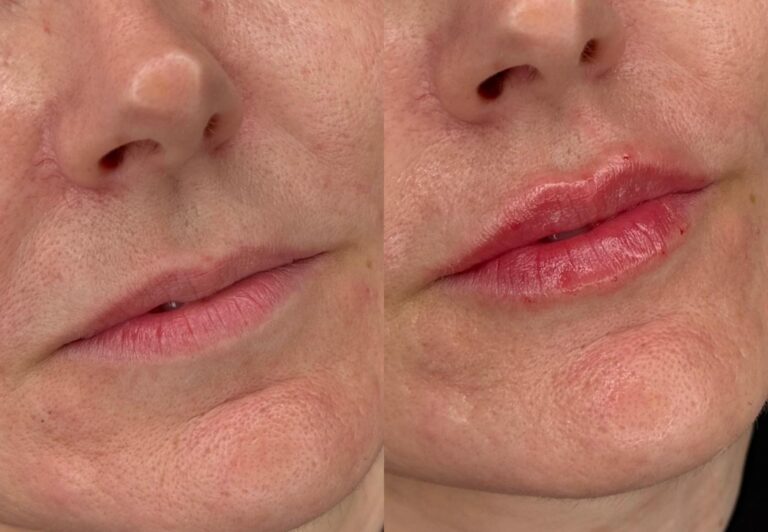 Relleno labios superior e inferior - resultado natural